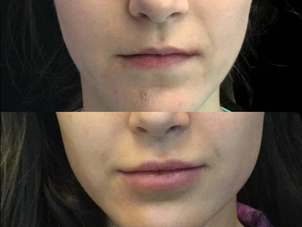 28-year-old-female-juvederm-before-and-after-front-view-25377.jpg