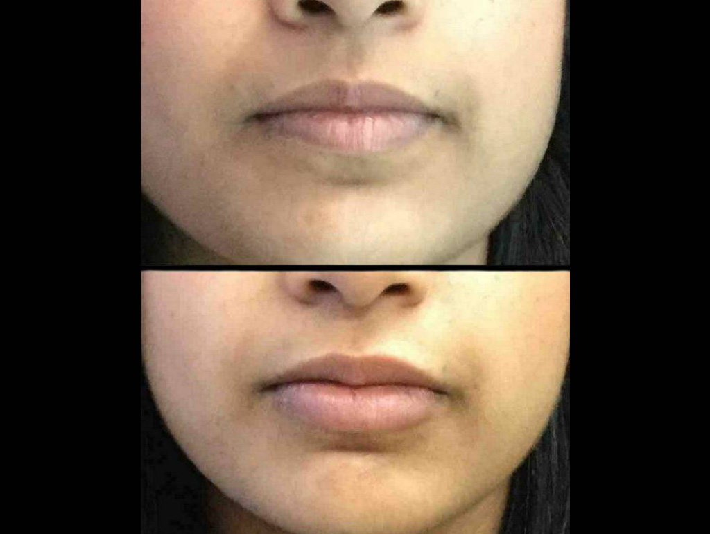 28-year-old-female-juvederm-before-and-after-front-view.jpg