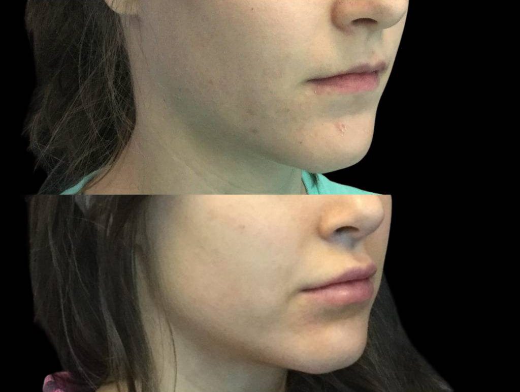 28-year-old-female-juvederm-before-and-after-three-quarter-view.jpg