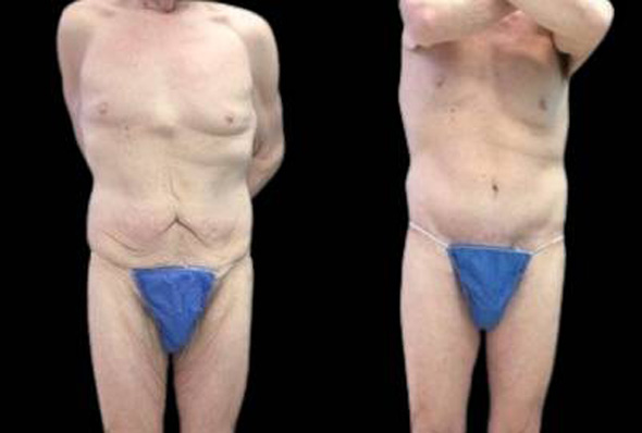 28-year-old-female-lower-body-lift-before-and-after-front-view.jpg