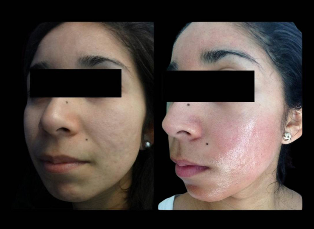 28-year-old-female-microneedling-before-and-after-1.jpg
