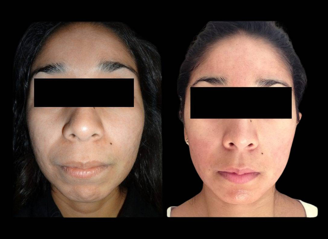 28-year-old-female-microneedling-before-and-after.jpg