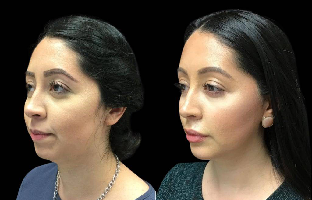 28-year-old-female-non-surgical-chin-augmentation-before-and-after.jpg