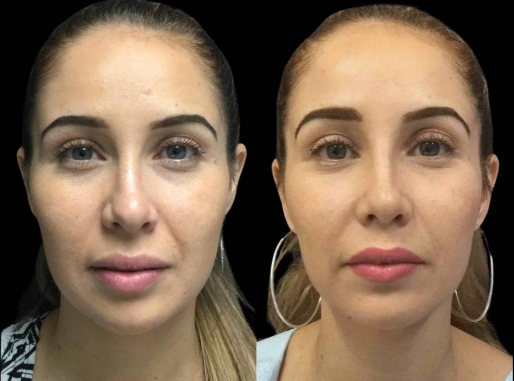 28-year-old-female-rhinoplasty-before-and-after-front-view-1.jpg