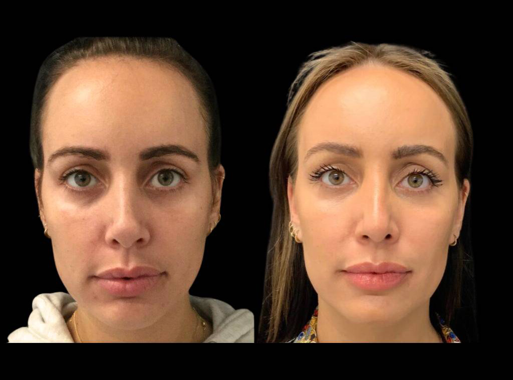 28-year-old-female-rhinoplasty-before-and-after-front-view-2.jpg