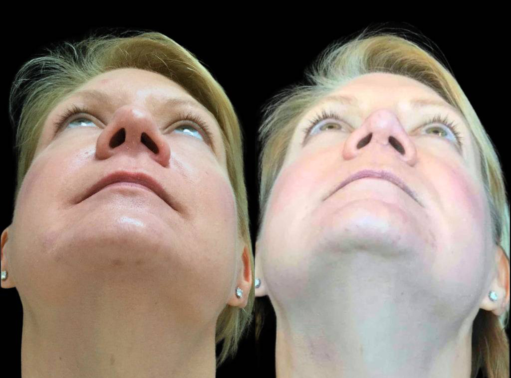 28-year-old-female-rhinoplasty-before-and-after-front-view.jpg