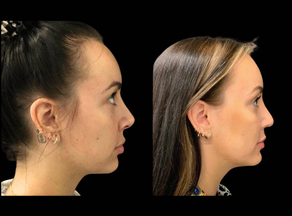 28-year-old-female-rhinoplasty-before-and-after-side-view.jpg