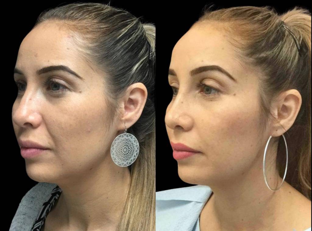 28-year-old-female-rhinoplasty-before-and-after-three-quarters-view-1.jpg