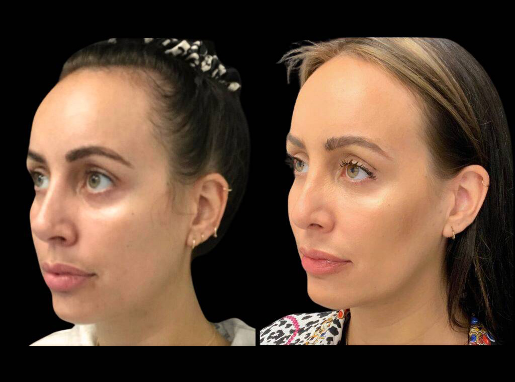 28-year-old-female-rhinoplasty-before-and-after-three-quarters-view-2.jpg
