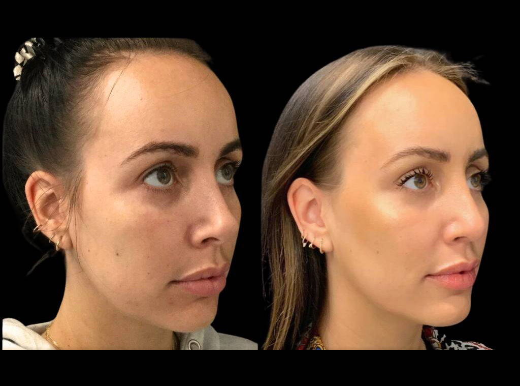 28-year-old-female-rhinoplasty-before-and-after-three-quarters-view-3.jpg