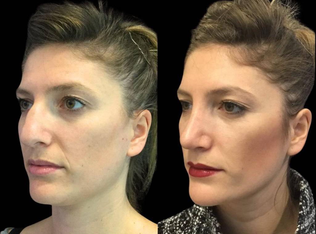 28-year-old-female-rhinoplasty-before-and-after-three-quarters-view.jpg
