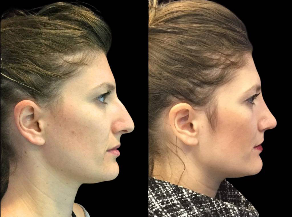 28-year-old-female-rhinoplasty-before-and-side-view.jpg