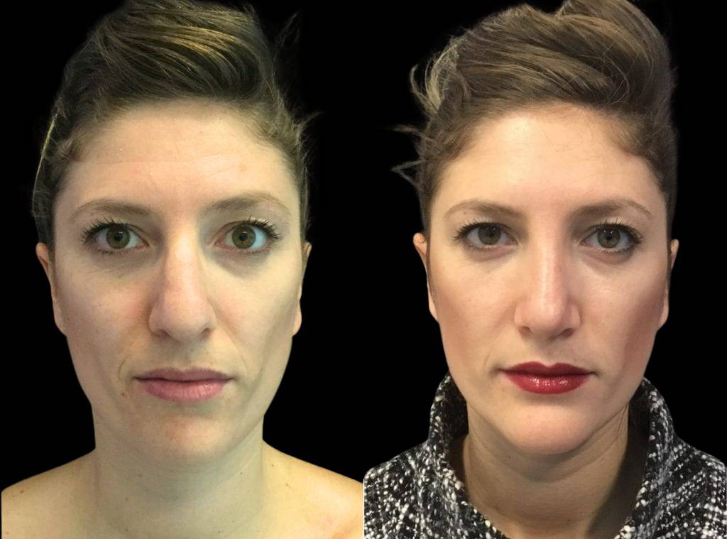 28-year-old-female-rhinoplasty-front-view.jpg