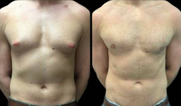 28-year-old-male-breast-reduction-before-and-after-front-view-19536.jpg