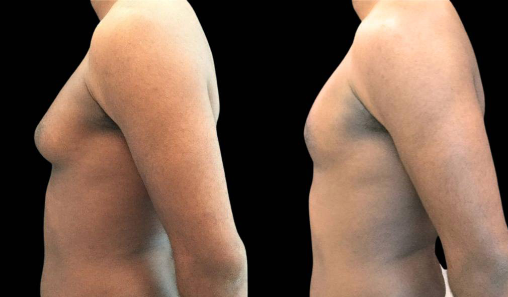 28-year-old-male-breast-reduction-before-and-after-side-view-1.jpg