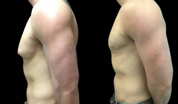 28-year-old-male-breast-reduction-before-and-after-side-view.jpg