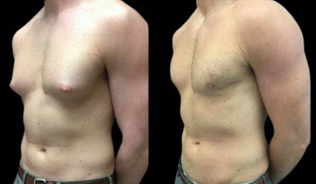28-year-old-male-breast-reduction-before-and-after-three-quarter-view.jpg