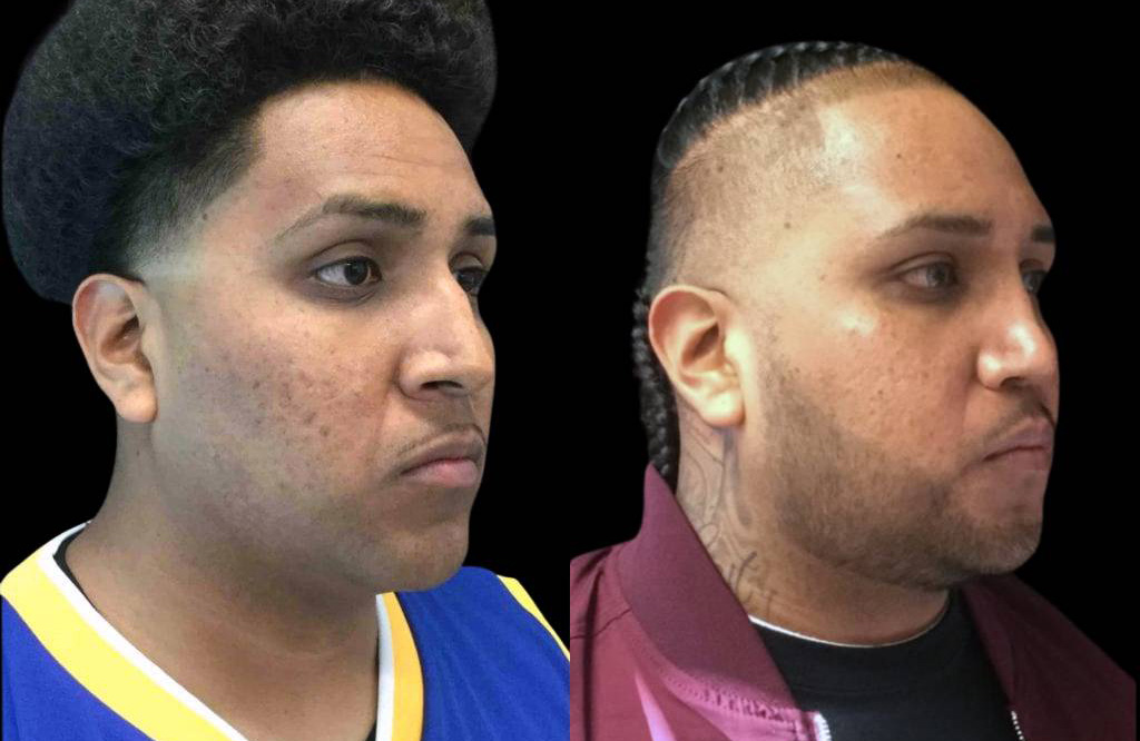 28-year-old-male-rhinoplasty-before-and-after-three-quarters-view-.jpg