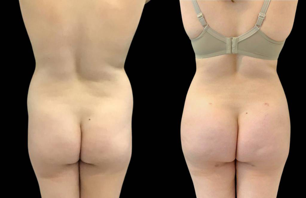 This is a 29-year-old female that has had a brazilian butt lift showing the before and after's side-by-side