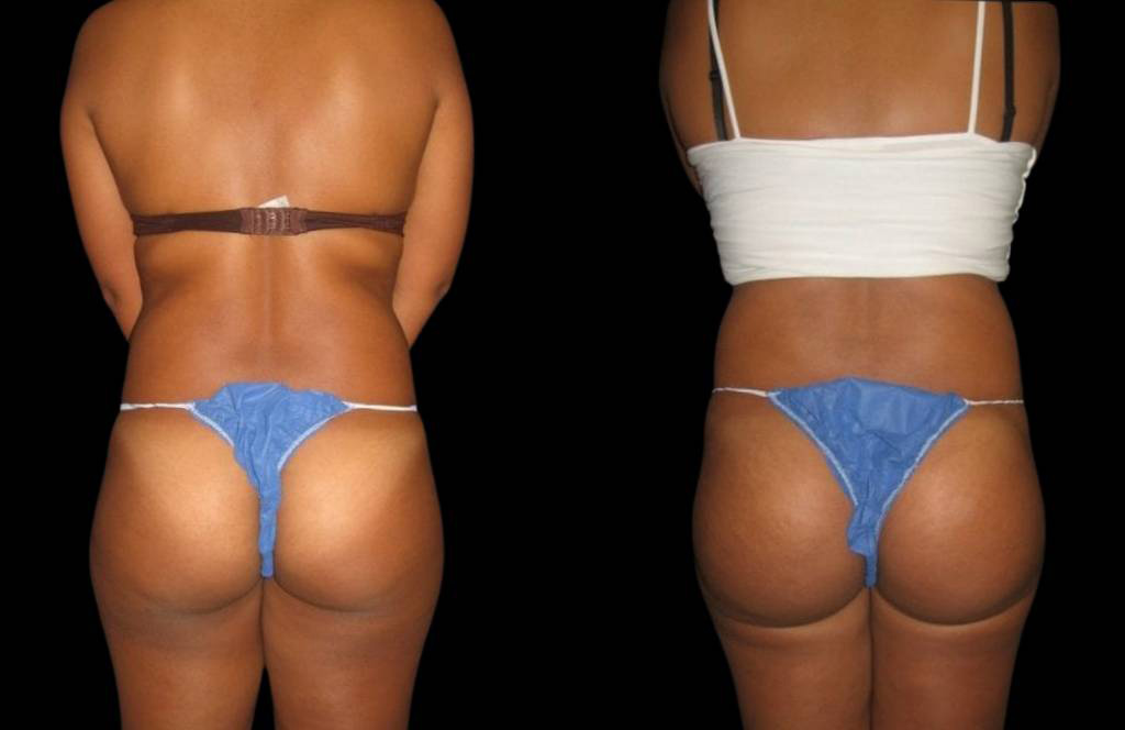 This is a 29-year-old female that has had a brazilian butt lift showing the before and after's side-by-side