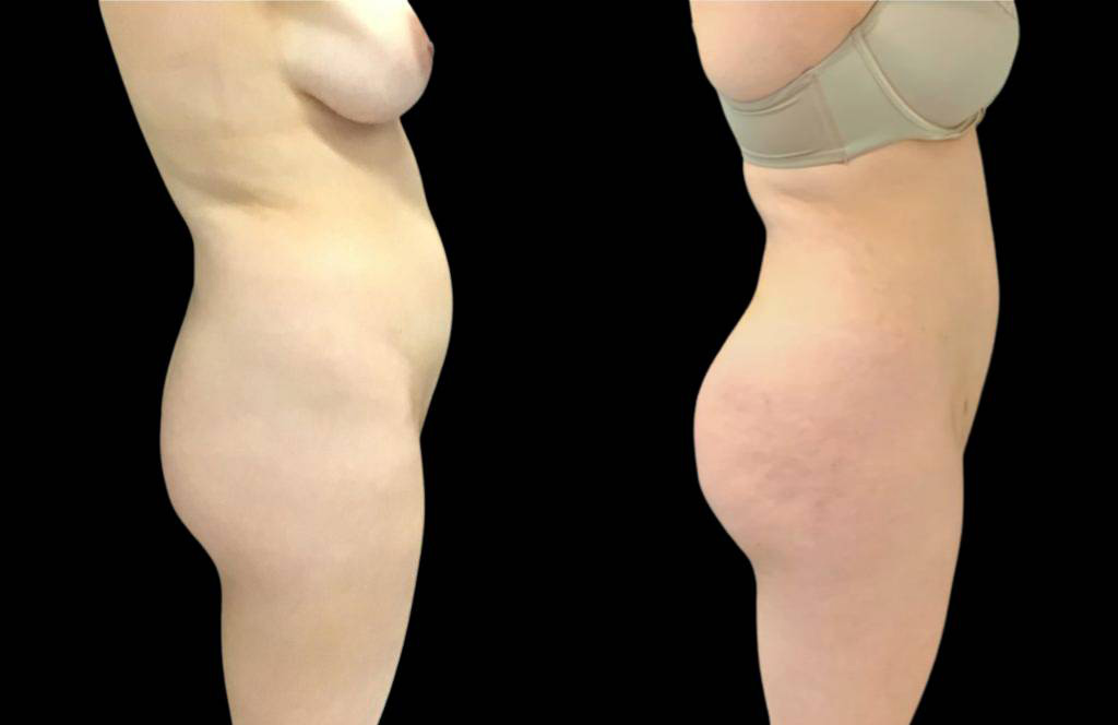 This is a 29-year-old female that has had a brazilian butt lift showing the before and after's side-by-side