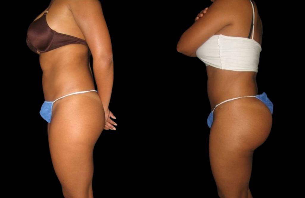 This is a 29-year-old female that has had a brazilian butt lift showing the before and after's side-by-side
