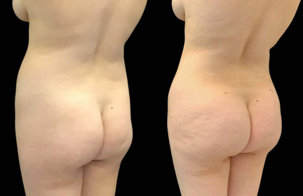 This is a 29-year-old female that has had a brazilian butt lift showing the before and after's side-by-side