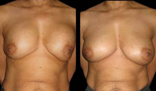 29-year-old-female-breast-implant-exchange-before-and-after-front-view.jpg