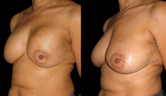 29-year-old-female-breast-implant-exchange-before-and-after-three-quarter-view.jpg