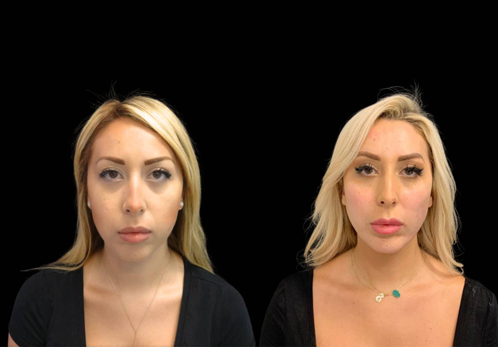 29-year-old-female-chin-implant-before-and-after-front-view-.jpg