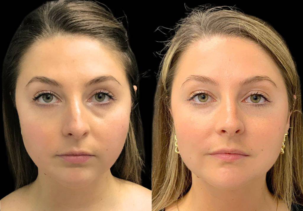 29-year-old-female-chin-implant-before-and-after-front-view.jpg