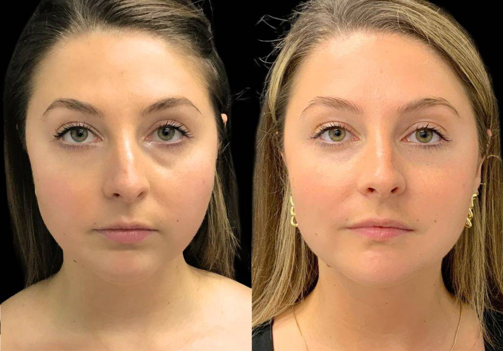 29-year-old-female-chin-implant-before-and-after-front-view.jpg