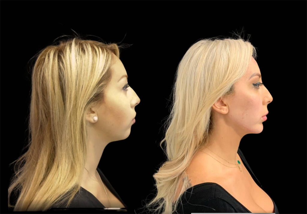 29-year-old-female-chin-implant-before-and-after-side-view-.jpg