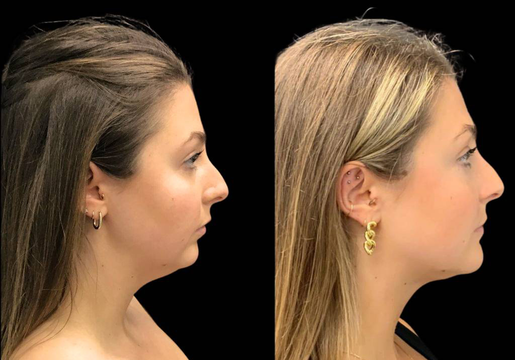 29-year-old-female-chin-implant-before-and-after-side-view.jpg