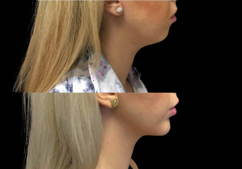 29-year-old-female-chin-implant-before-and-after-side-view-7184.jpg