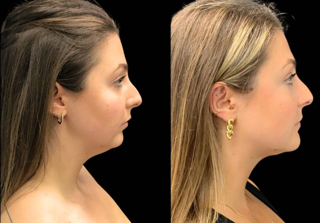 29-year-old-female-chin-implant-before-and-after-side-view.jpg