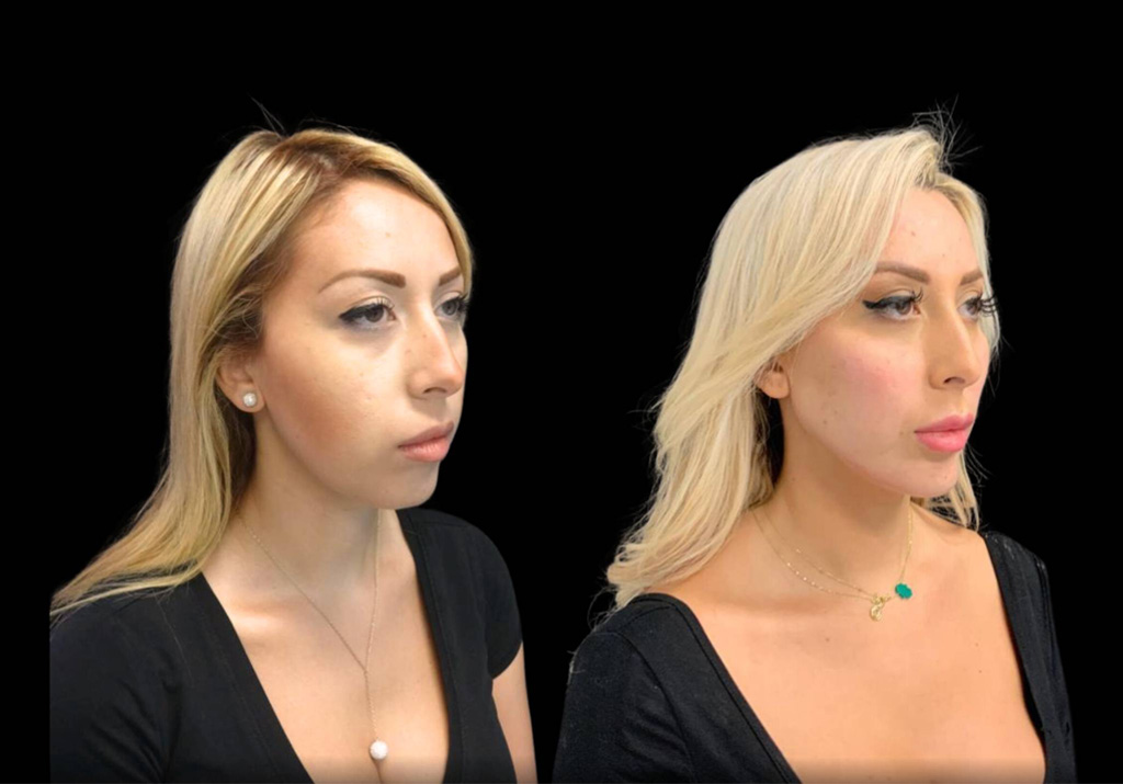 29-year-old-female-chin-implant-before-and-after-three-quarters-view-.jpg