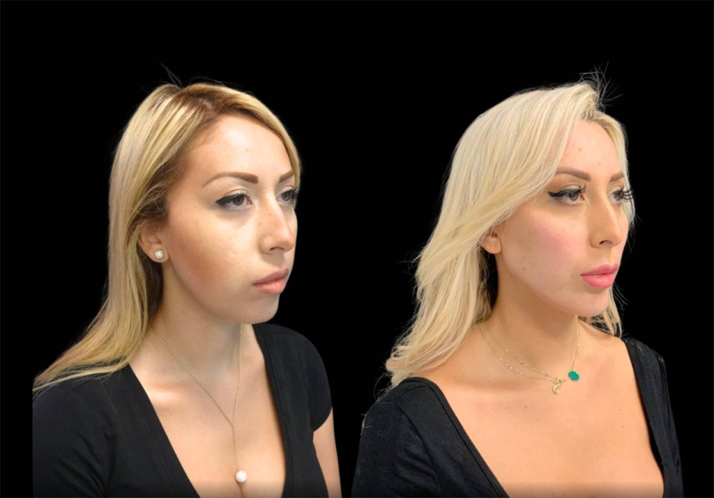 29-year-old-female-chin-implant-before-and-after-three-quarters-view-.jpg