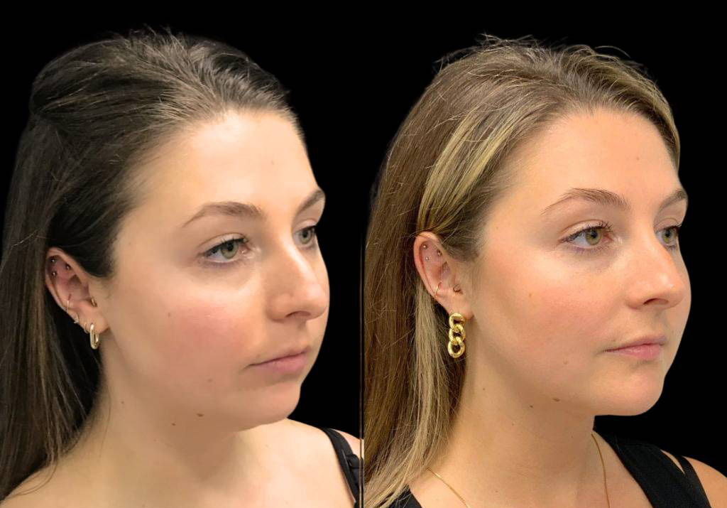29-year-old-female-chin-implant-before-and-after-three-quarters-view-34471.jpg