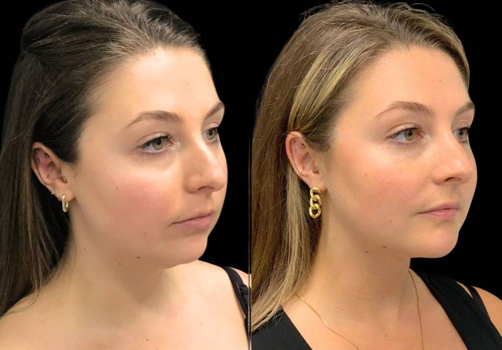 29-year-old-female-chin-implant-before-and-after-three-quarters-view-34471.jpg