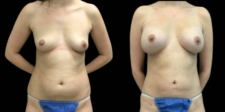This is a 29-year-old female that has had a breast augmentation and implant showing the before and after's side-by-side