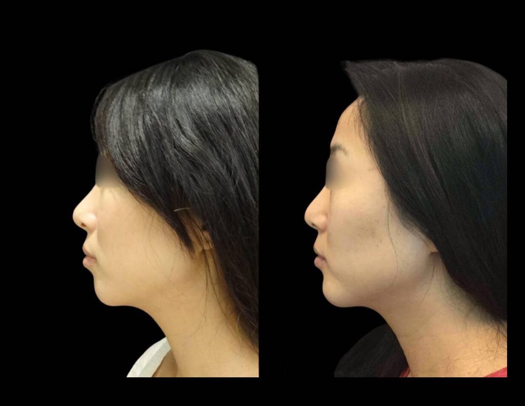 29-year-old-female-non-surgical-chin-augmentation-before-and-after-1.jpg