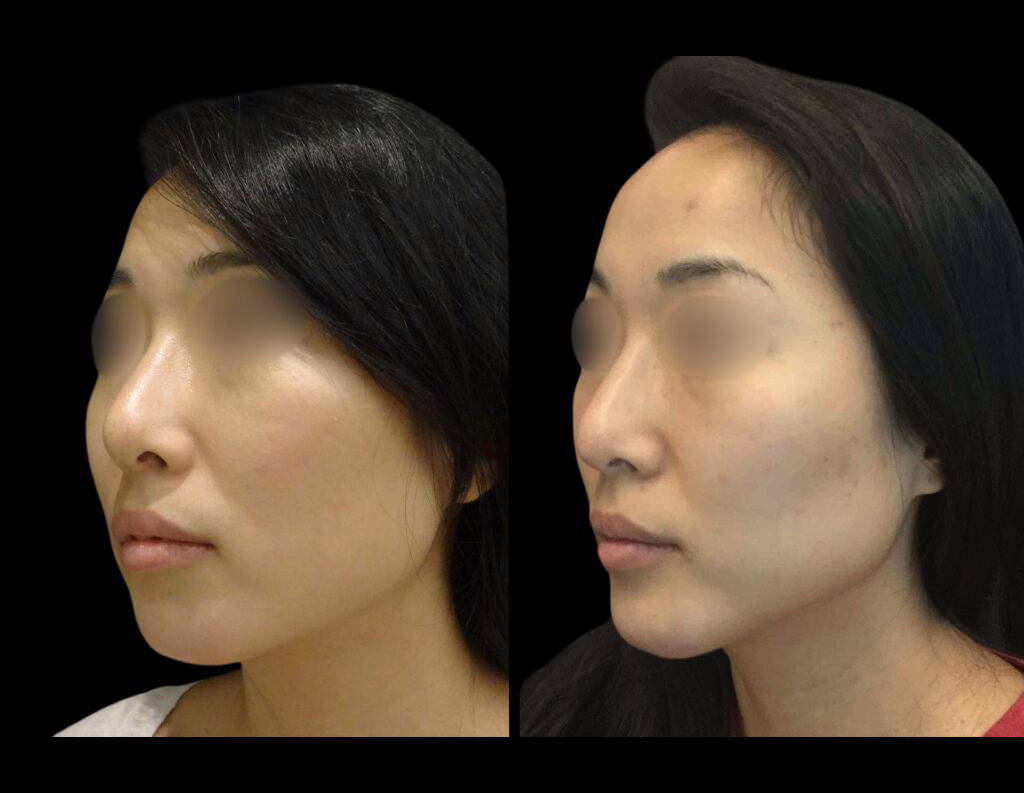 29-year-old-female-non-surgical-chin-augmentation-before-and-after.jpg