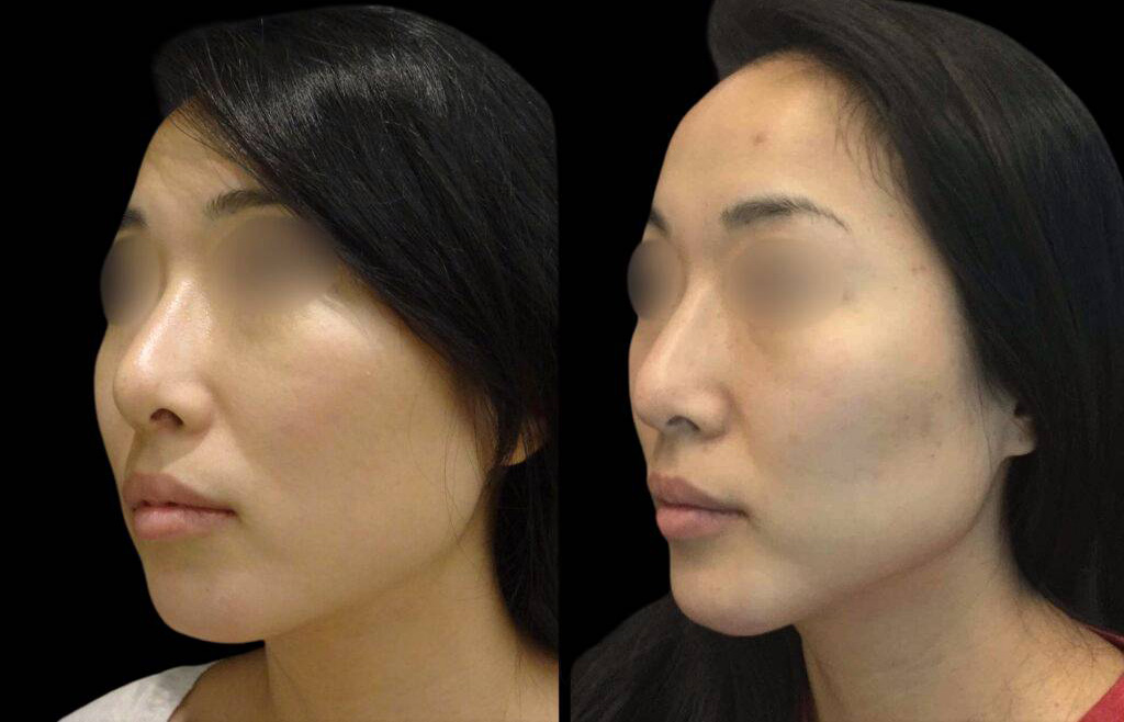 29-year-old-female-non-surgical-chin-augmentation-before-and-after.jpg