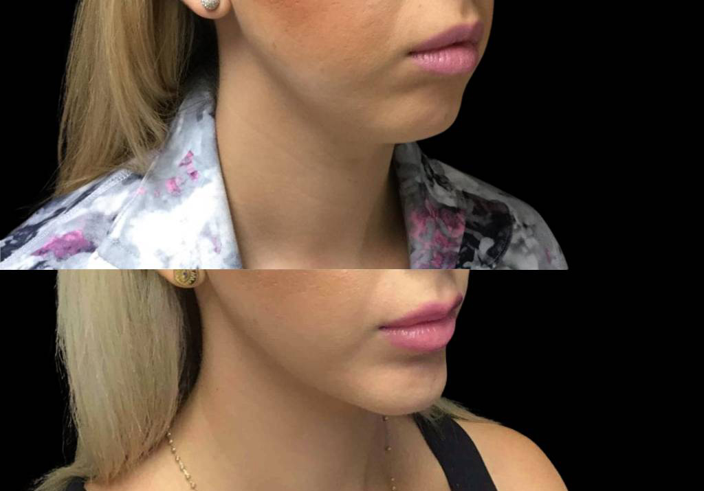 29-year-old-female-non-surgical-facelift-before-and-after-three-quarters-view-1.jpg
