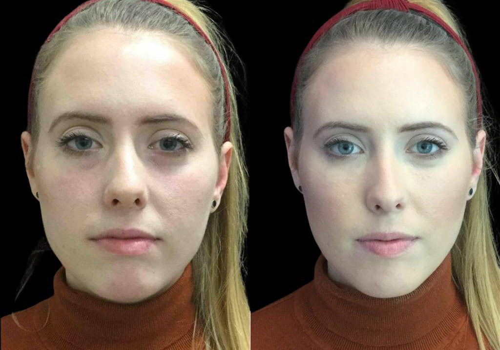29-year-old-female-restylane-lift-before-and-after-front-view-25491.jpg