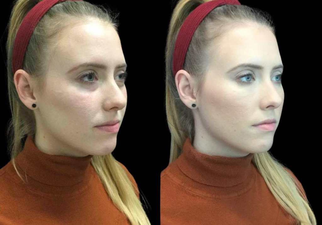 29-year-old-female-restylane-lift-before-and-after-three-quarter-view.jpg