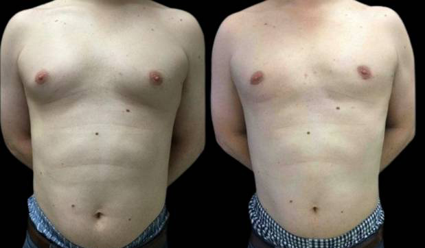 29-year-old-male-breast-reduction-before-and-after-front-view-21988.jpg