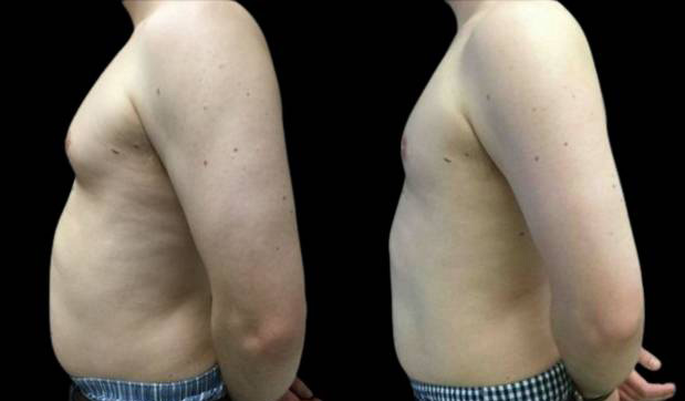 29-year-old-male-breast-reduction-before-and-after-side-view.jpg