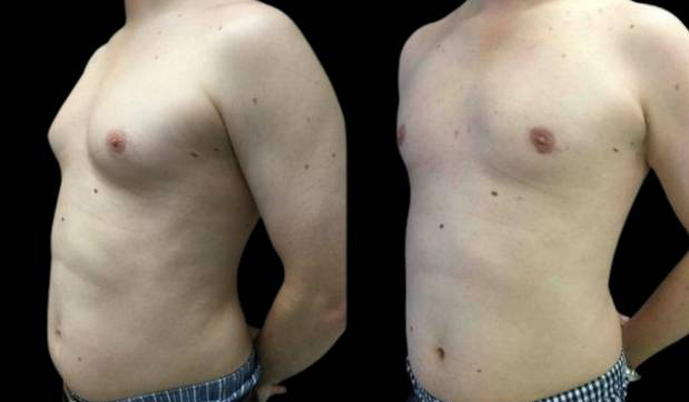 29-year-old-male-breast-reduction-before-and-after-three-quarter-view-1.jpg
